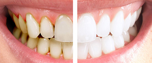 Dental x-ray. teeth whitening. Restorative care. 