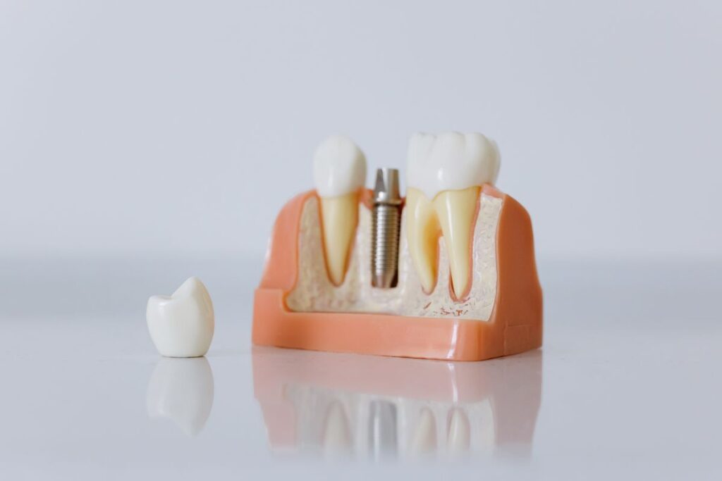 Close-up of a dental implant model showing the implant post and crown