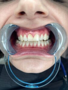 Close-up of teeth during a dental exam for tooth discolouration