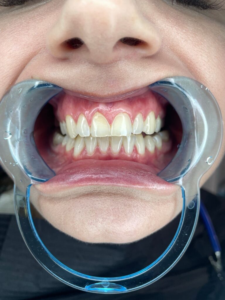 Close-up of teeth during a dental exam for tooth discolouration